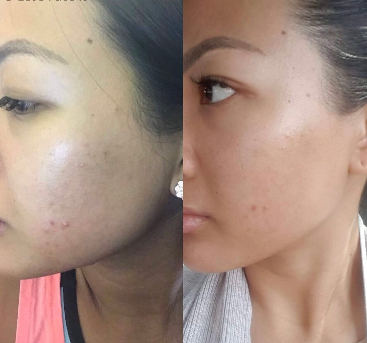 Duo Peel Shot Glow Rice Ampoule